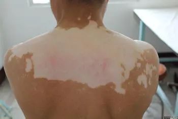 白癜风的治疗应遵循的原则标题