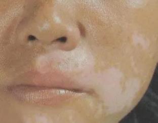 嘴角出现白斑怎么治疗