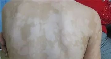 为什么会得白斑?