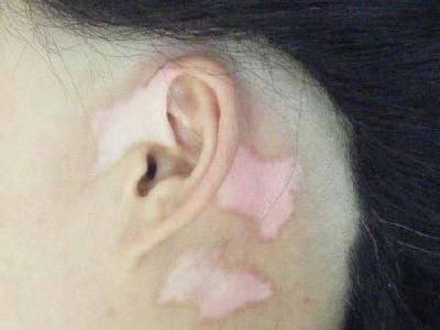 皮肤白斑很小还要治疗吗?