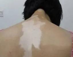 白点癜风的预防措施有哪些?